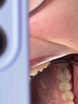 Степень поражения зуба фото 2