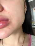 Сыпь вокруг рта, аллергия или нет? фото 3