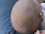 Желтоватые коросты на голове у 7 месячного ребенка фото 1