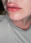 Комки в губах после увеличения спустя месяц фото 2