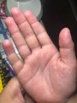 Шелушатся руки у ребёнка 6 лет фото 1