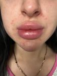 Сыпь вокруг рта, аллергия или нет? фото 2