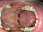 Сыпь в полости рта у ребёнка фото 1