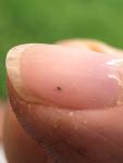 Черное маленькое пятно на ногте большого пальца, болезненно фото 1