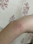 Сухой участок на руке, как аллергия фото 3
