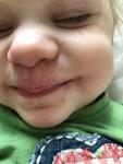 Сыпь вокруг рта у ребёнка фото 1