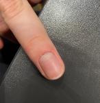 Повреждение ногтя и кожи фото 2