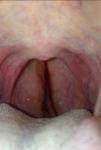 Красное горло без кашля и боли фото 1