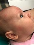 Сыпь на голове у новорожденного фото 1
