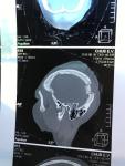 Перелом основания черепа фото 1