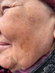 Пятно на лице, лентиго-меланома? фото 2