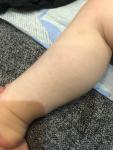 Сыпь у ребёнка по всему телу фото 4