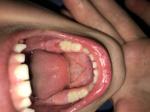 Режется зуб у ребёнка в 5 лет фото фото 1