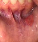 Пузырь на внутренней стороне губы фото 1