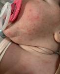 Сыпь у новорождённого аллергия или акне фото 1