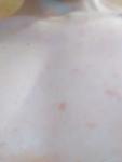 Красные пятна на груди у подростка 17 лет фото 1