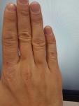 Потемнение кожи на трёх пальцах руки фото 2