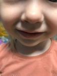 Белое пятно на нижней губе у ребёнка фото 1