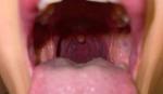 Ком в горле, оранжевые пятна на горле, миндалины асимметричны фото 2