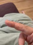 Экзема или дерматит на пальцах рук фото 1