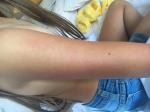 Сыпь у ребенка после солнечного ожога фото 1