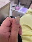 Меланома ногтя или невус? Коричневая полоска на ногте фото 4