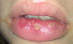 Воспаление в полости рта фото 1
