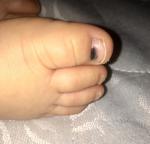 У годовалого ребенка черное пятно на ногте фото 1