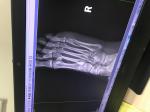 Перелом 5 плюсневой кости на правой ноге фото 1