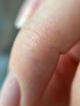 Раздражение/трещинки на сгибах пальцев рук фото 3