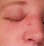 Опух нос, через 2 недели после перелома фото 1