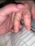 Гнойнички на пальцах у ребёнка фото 1