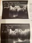 Протокол УЗИ органов малого таза, варикоз фото 2