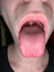 Пупырышки на конце языка без симптомов фото 1