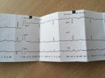 Боли В области сердца, кардиограмма фото 3