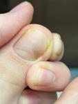 Коричневое пятно на ногте -это меланома? фото 3
