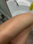 Сыпь на внутренней стороне рук летом/ при смене места фото 1