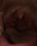 Боль в горле, язвочки, хронический тонзиллит фото 1