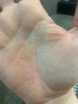 Глубокие трещины на стопах и пальцах рук. Гиперкератоз или псориаз? фото 3
