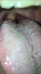 Шишка на миндалине, сухой кашель, лимфаденопатия шейная фото 1