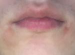 Красные шелушащиеся пятна вокруг губ фото 1