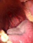 Шишки в горле, тонзиллит, увеличены лимфоузлы фото 1