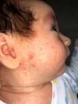 Цветение младенца или пищевая аллергия фото 1