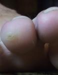 Уплотнение кожи на пальце ноги фото 1