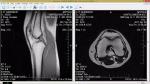 Здравствуйте! Помогите, пожалуйста, с расшифровкой МРТ коленного сустава фото 3