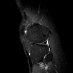 Гиперчуствительность сухожилия ниже колена снаружи фото 4