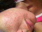 Аллергическая сыпь на лице фото 1
