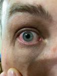 Покраснение глаза с легким болевым синдромом фото 1