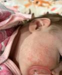 Акне новорожденных или аллергия? фото 1
