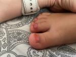 Воспаление на пальце ноги у ребёнка фото 2